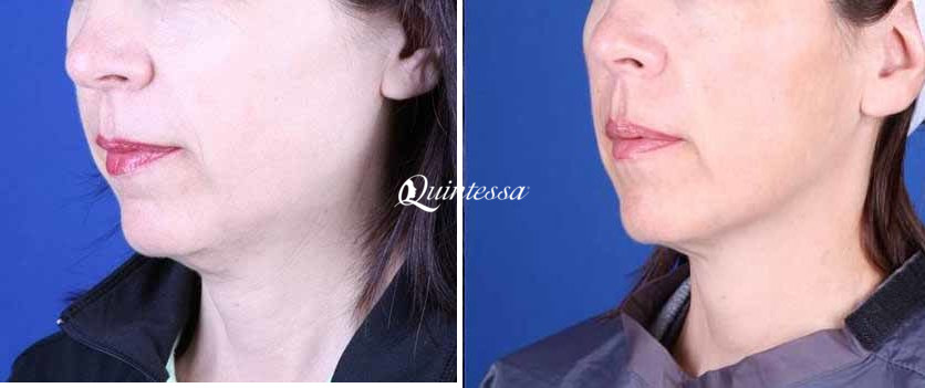 Neck Lift Before and After Photos in Delafield, WI, Patient 20160
