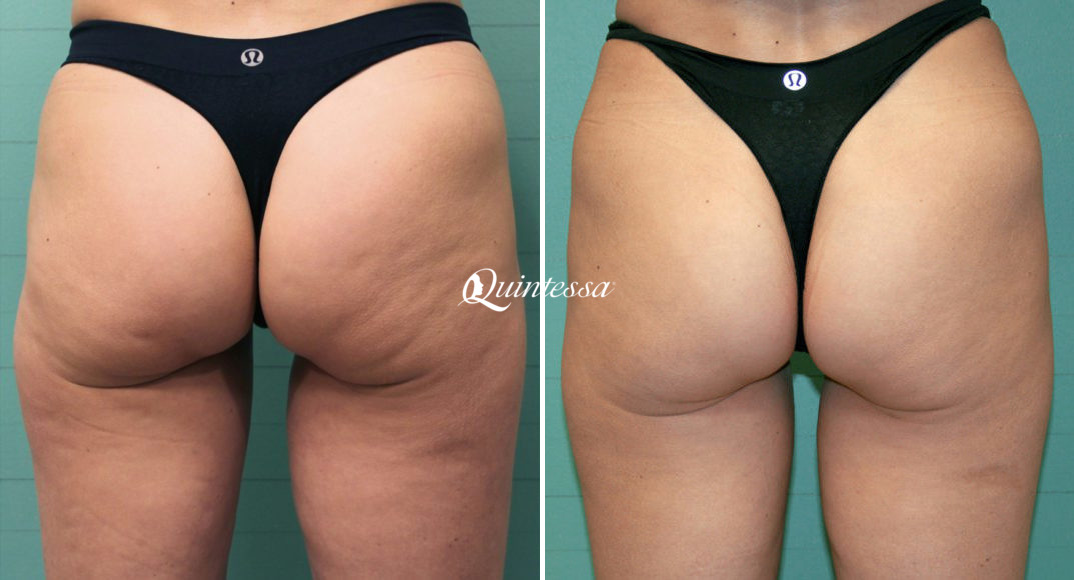 Brazilian Butt Lift Before and After Photos in Madison, WI, Patient 20165