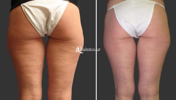 Brazilian Butt Lift Before and After Photos in Madison, WI, Patient 20168