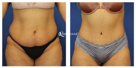 Tummy Tuck Before and After Photos in Madison, WI, Patient 20172