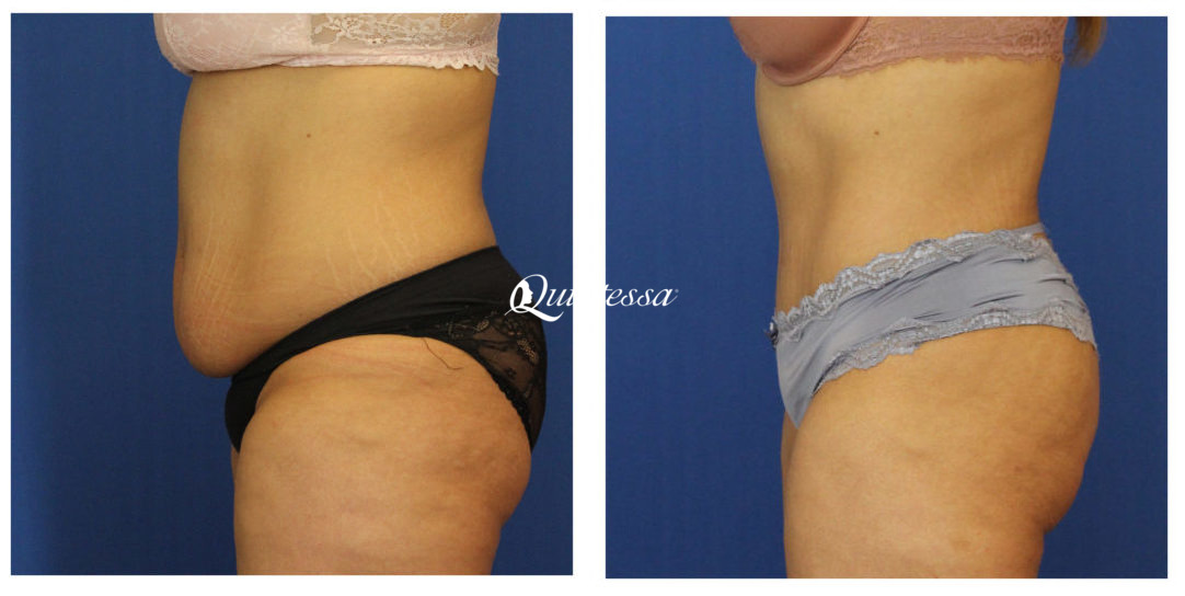 Tummy Tuck Before and After Photos in Mequon, WI, Patient 20177