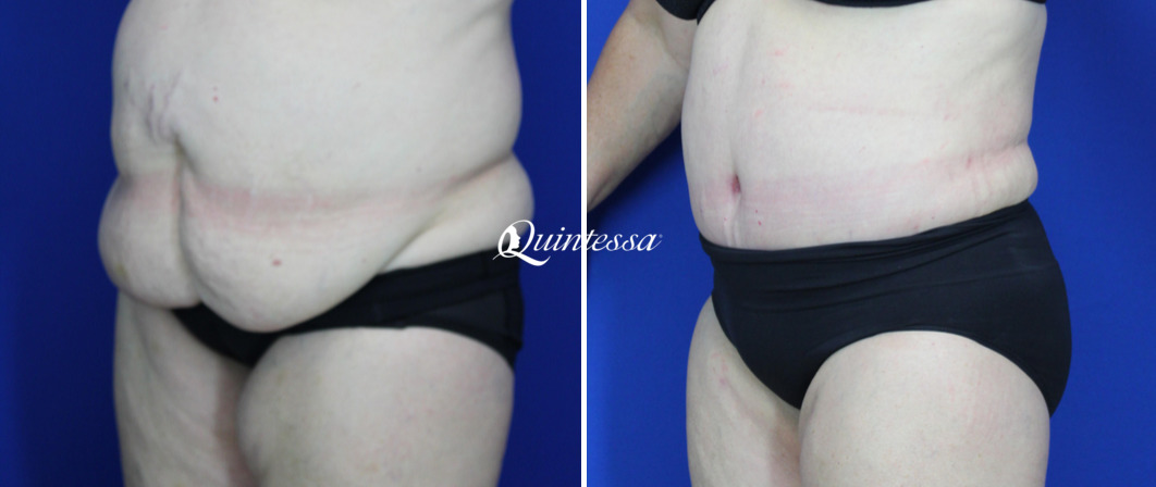 Tummy Tuck Before and After Photos in Mequon, WI, Patient 20181