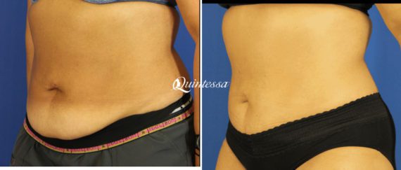 Tummy Tuck Before and After Photos in Middleton, WI, Patient 20185