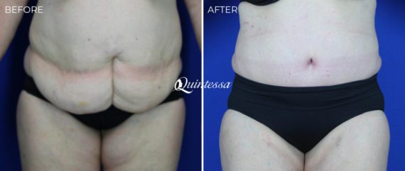 Tummy Tuck Before and After Photos in Mequon, WI, Patient 20189