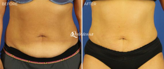 Tummy Tuck Before and After Photos in Middleton, WI, Patient 20193