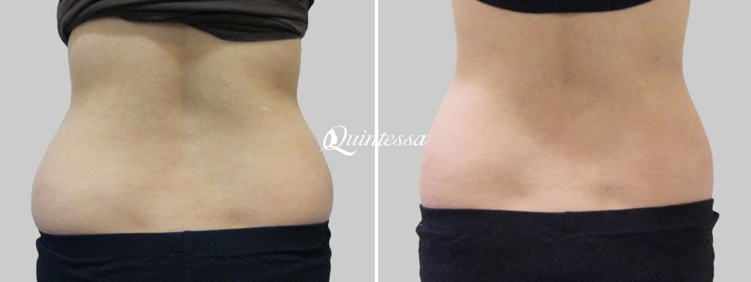 Tummy Tuck Before and After Photos in Middleton, WI, Patient 20200