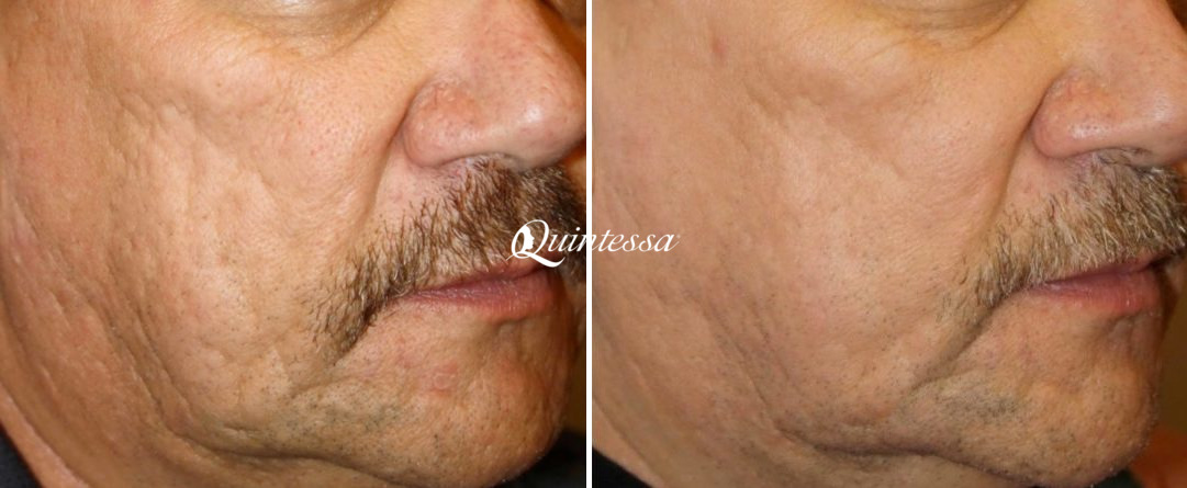 Halo Laser Before and After Photos in Madison, WI, Patient 20204