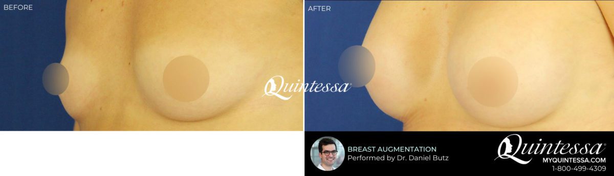 Breast Augmentation Before and After Photos in , , Patient 20264