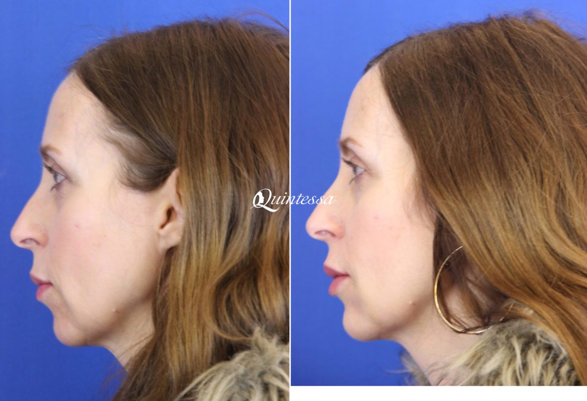Fillers Before and After Photos in Sheboygan, WI, Patient 20287
