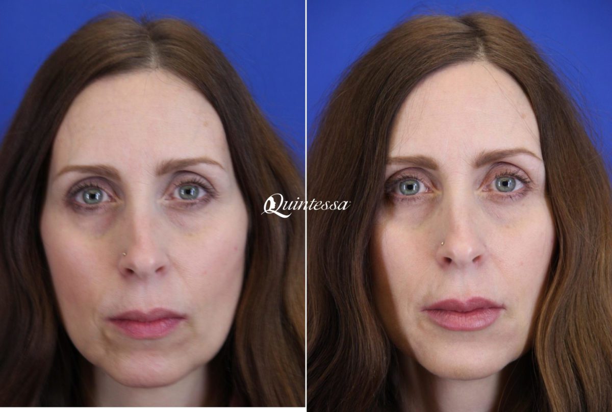 Fillers Before and After Photos in Middleton, WI, Patient 20291