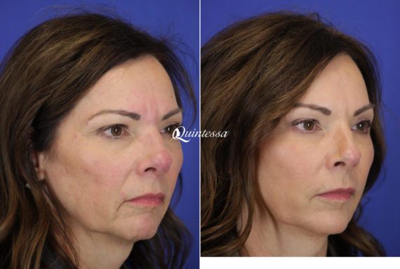 Fillers Before and After Photos in Sheboygan, WI, Patient 20295