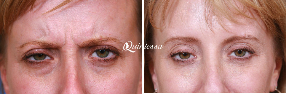 Botox Before and After Photos in Mequon, WI, Patient 20301