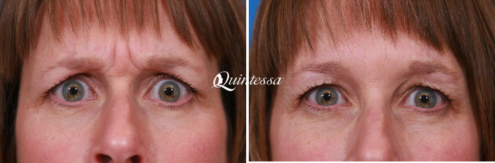 Botox Before and After Photos in Middleton, WI, Patient 20305
