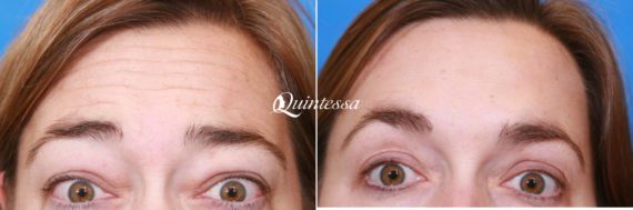 Botox Before and After Photos in Middleton, WI, Patient 20310