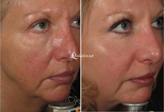 Halo Laser Before and After Photos in Mequon, WI, Patient 20314