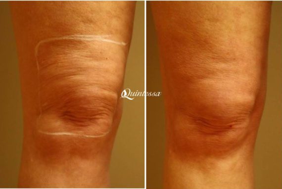 Halo Laser Before and After Photos in Delafield, WI, Patient 20318
