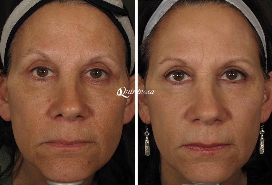 Halo Laser Before and After Photos in Delafield, WI, Patient 20322