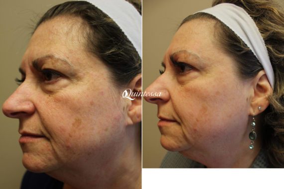 BBL Laser Facial Before and After Photos in Madison, WI, Patient 20326