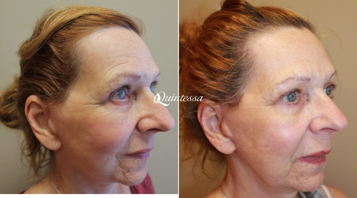 BBL Laser Facial Before and After Photos in Sheboygan, WI, Patient 20330