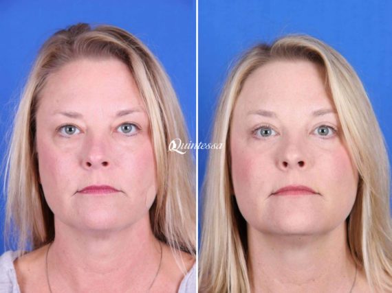 Thread Lift Before and After Photos in Mequon, WI, Patient 20334