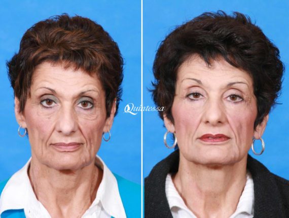 Thread Lift Before and After Photos in Middleton, WI, Patient 20338