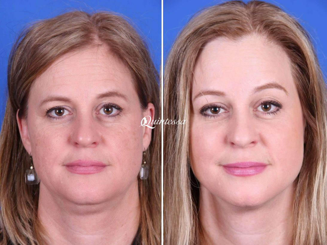 Thread Lift Before and After Photos in Middleton, WI, Patient 20342