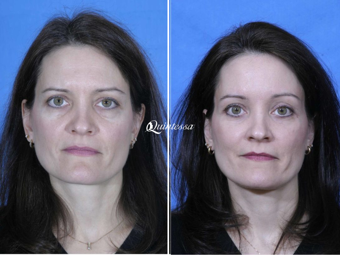 Thread Lift Before and After Photos in Madison, WI, Patient 20346