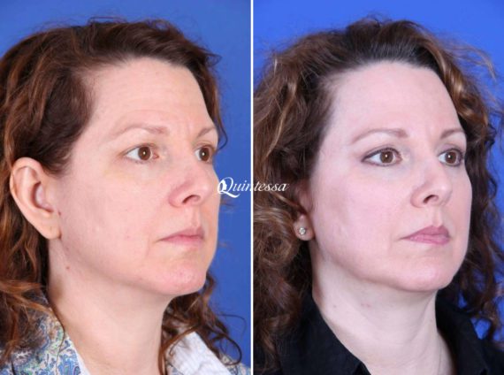 Thread Lift Before and After Photos in Middleton, WI, Patient 20350