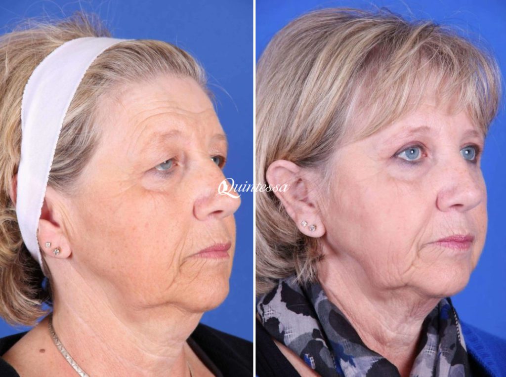 Thread Lift Before and After Image