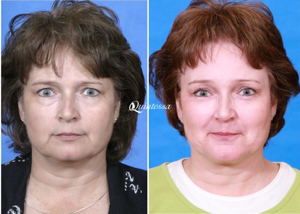 Thread Lift Before and After Images