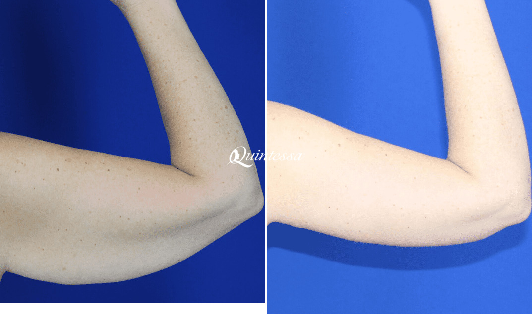 Arm Lift Before and After Photos in Mequon, WI, Patient 20362