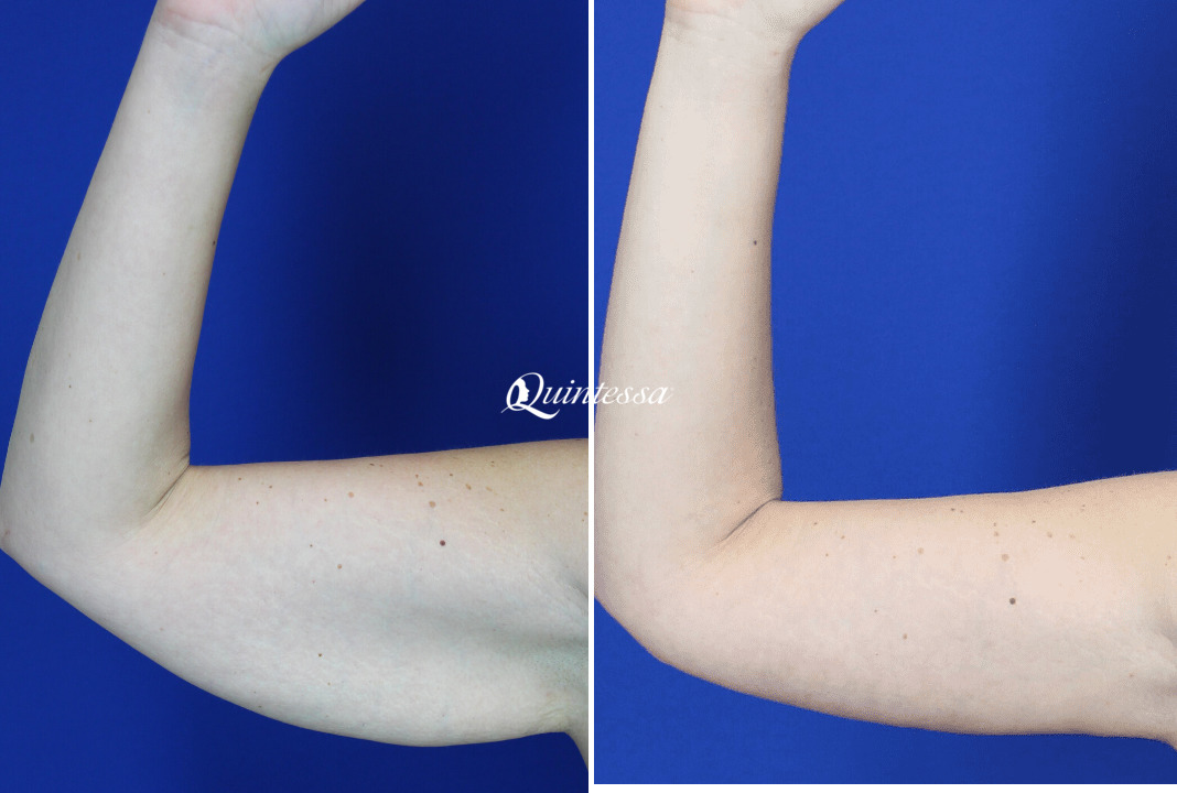 Arm Lift Before and After Photos in Middleton, WI, Patient 20369