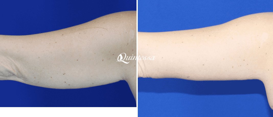 Arm Lift Before and After Photos in Delafield, WI, Patient 20373
