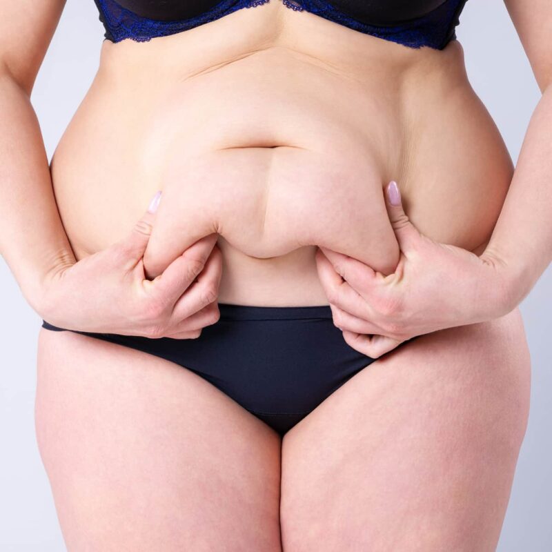 A postpartum belly with diastasis recti reflects the intense journey of pregnancy and childbirth.