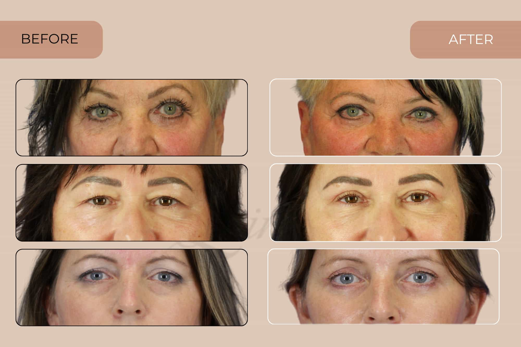 Check out the before and after photos of clients at Quintessa who have had eyelid surgery.