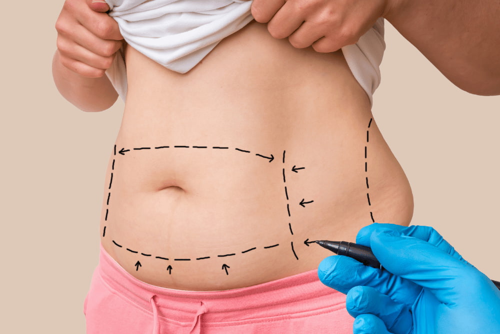 A tummy tuck involves a horizontal incision, liposuction, muscle tightening, and contour sculpting.