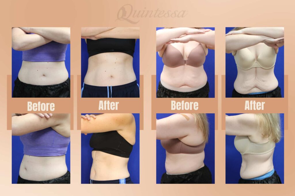 A transformative before-and-after image showcasing the remarkable results achieved by Quintessa patients.