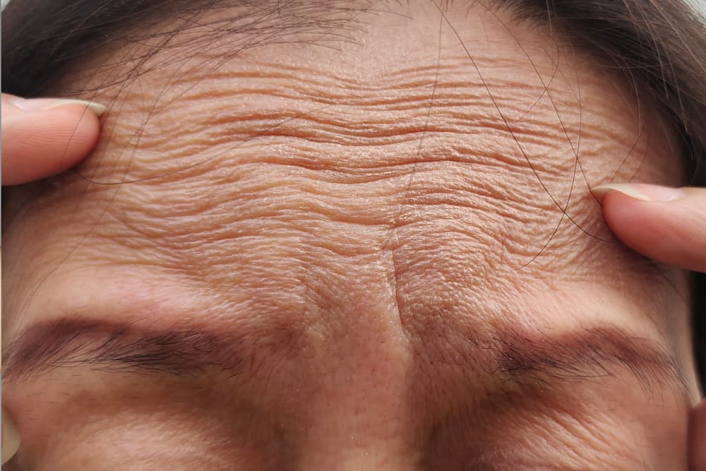 Ideal candidates for a brow lift in Milwaukee have asymmetric brows and forehead wrinkles.