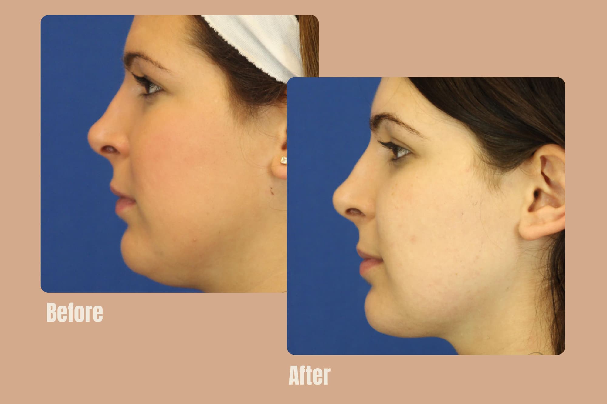 Before and after comparison highlighting the reduced fat around the chin and jawline, creating a slimmer, more defined appearance.