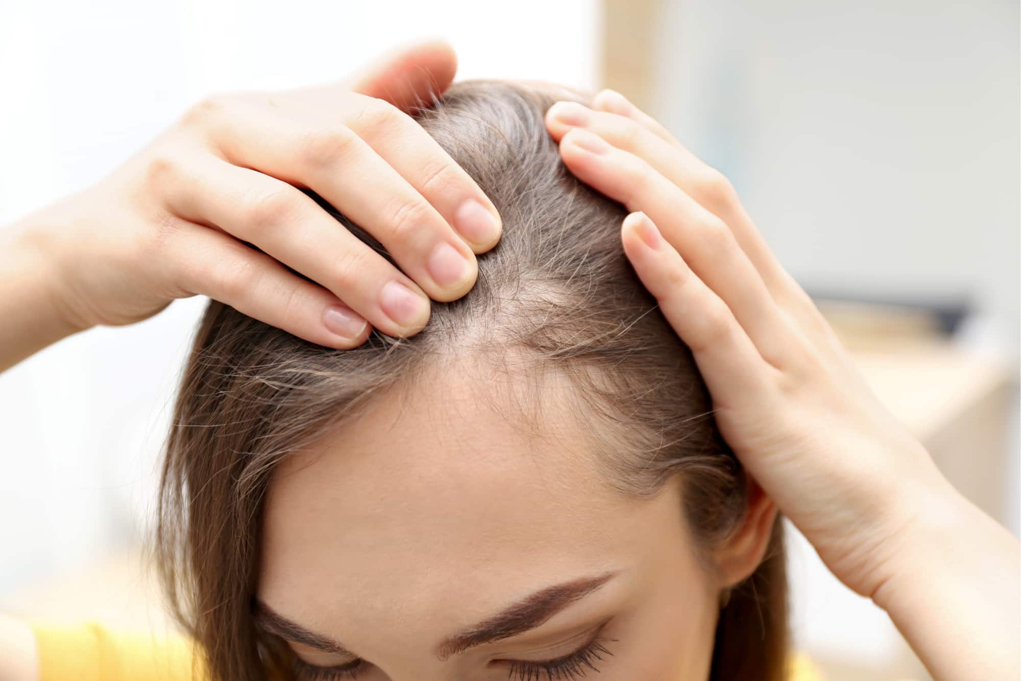 Early to moderate hair thinning responds well to PRP therapy for regrowth.