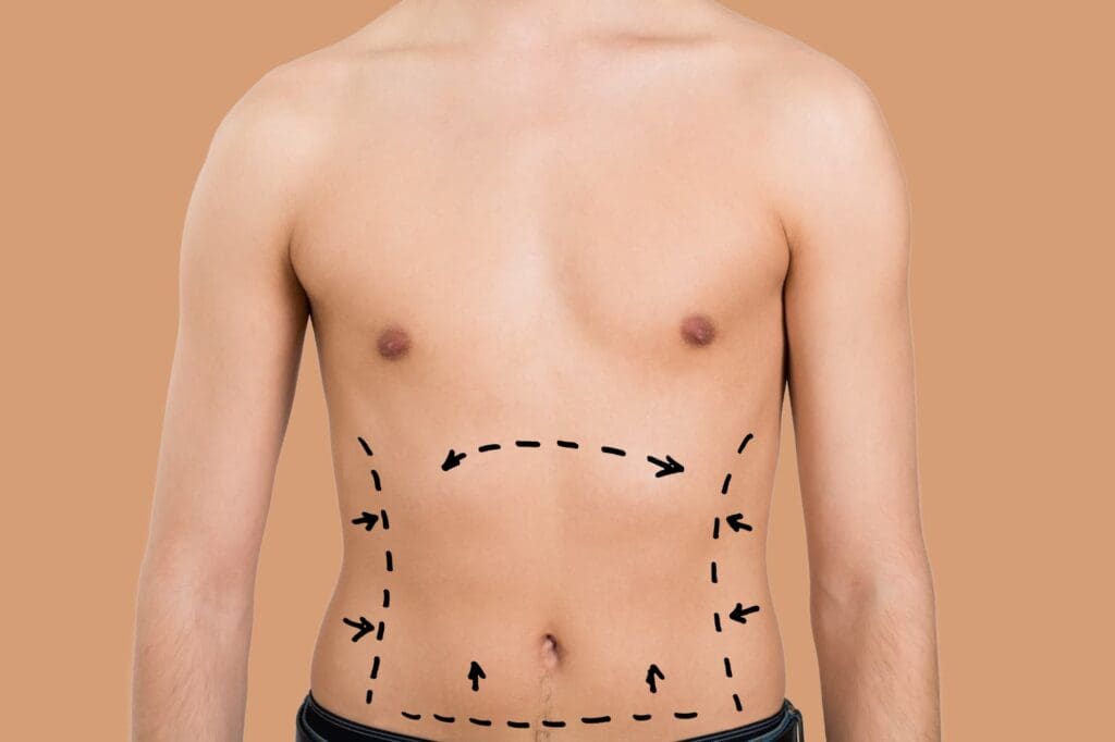 Liposuction services in Mequon targeting multiple body areas for precise fat removal.