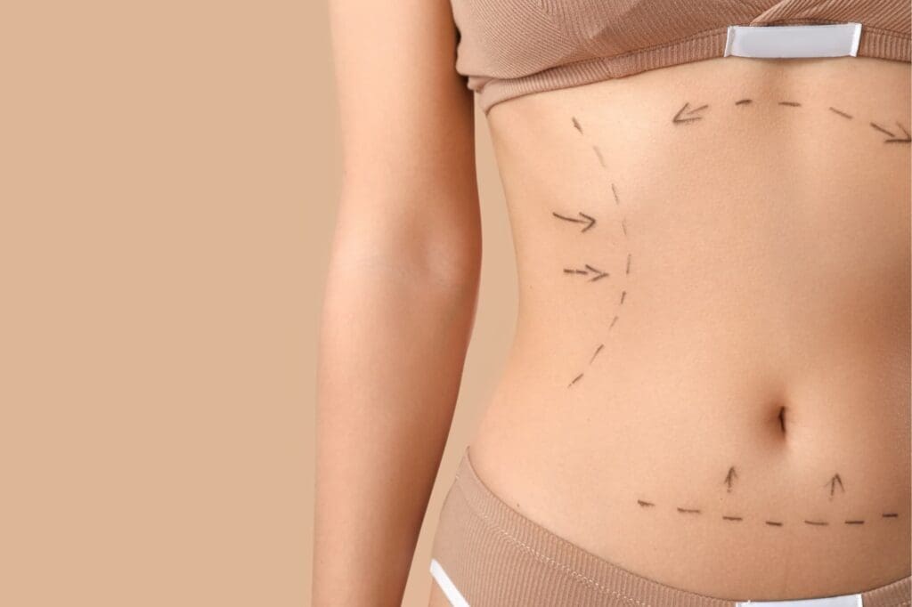 Ideal Middleton liposuction candidates have firm skin, good muscle tone, and seek to improve their body shape.