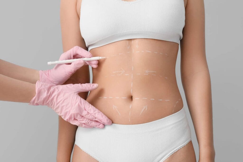 Liposuction treatment targeting areas such as the abdomen to reduce stubborn belly fat and enhance body contour.