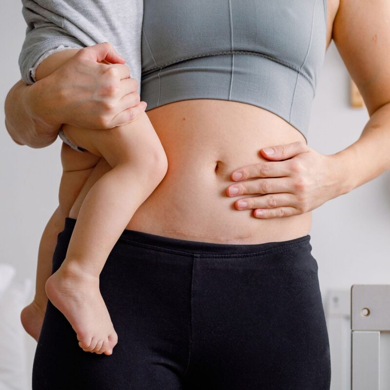 woman holding her baby before getting a mommy makeover after her c-section in Milwaukee, WI