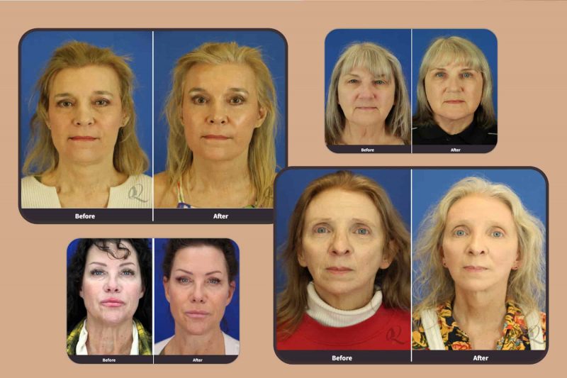 Side-by-side patient images revealing subtle yet significant facial rejuvenation results.