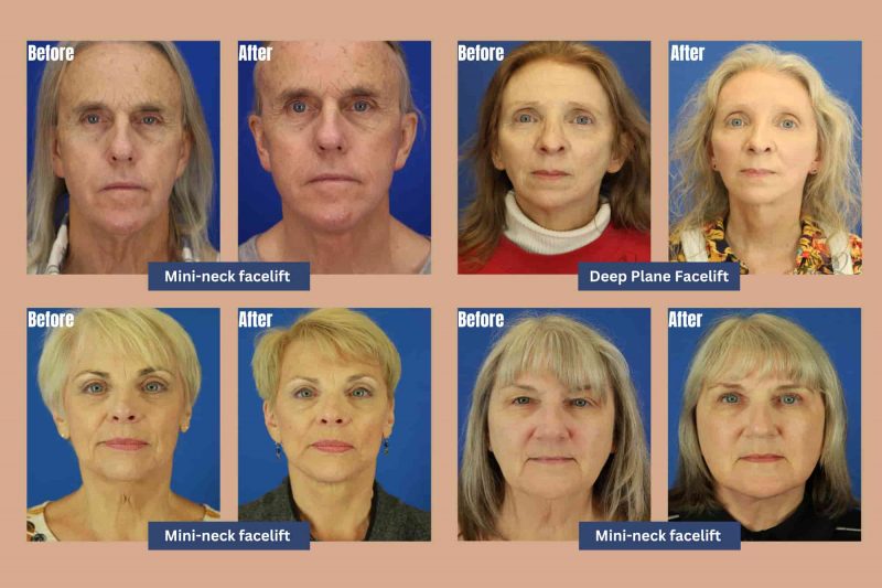 Before and after photos showcasing facelift surgery results by Quintessa in Milwaukee, Wisconsin.