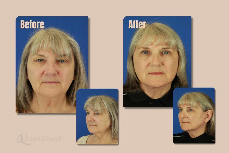 The power of a facelift at Quintessa: Before and after images show enhanced facial contours and a refreshed appearance.