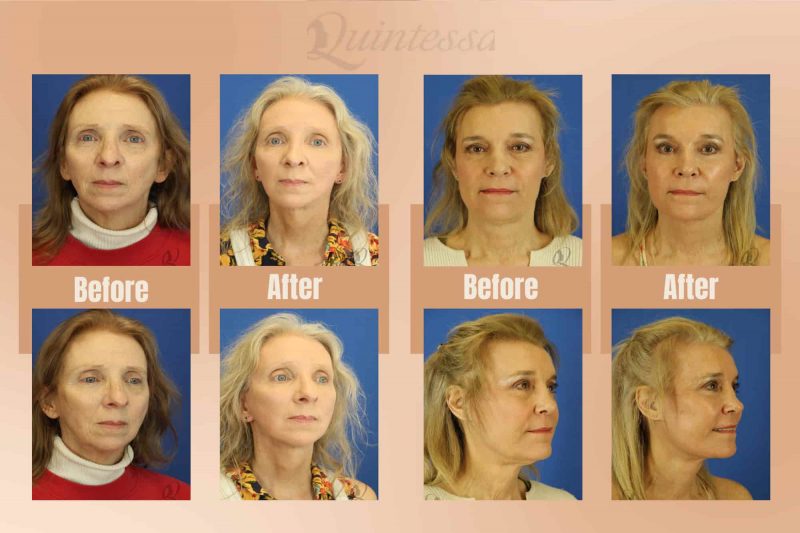 Before and after results of facelift surgery in Waukesha highlight restored facial definition, smoother skin, and a more youthful, refreshed look.