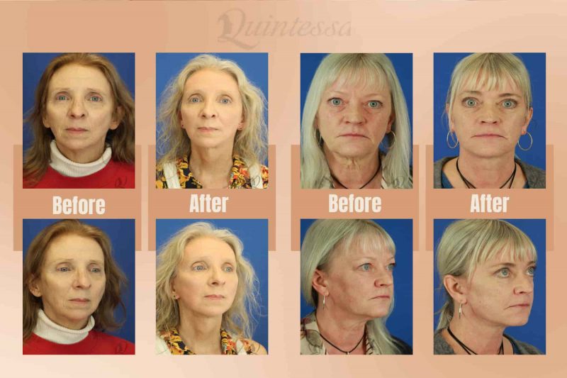 Before and after facelift photos highlighting enhanced skin elasticity.