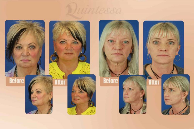 Side-by-side comparison showing a more youthful, radiant appearance post-facelift surgery.